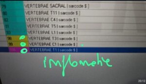 spondiloza cervicală