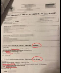 spondiloza cervicală