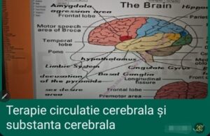 spondiloza cervicală