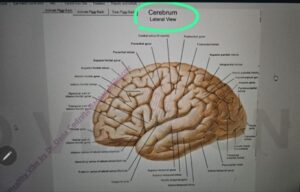 spondiloza cervicală