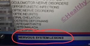 spondiloza cervicală