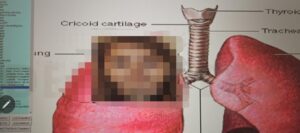 Viroză respiratorie cu laringită