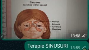 Viroză respiratorie cu laringită