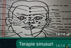 Viroză respiratorie cu laringită